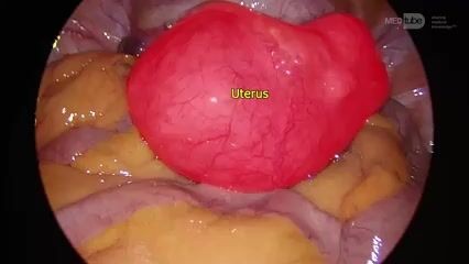 Total Laparoscopic Hysterectomy Intemediate Level