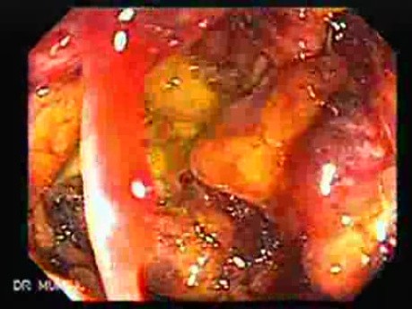 Toxic Dilatation Of The Colon Superimposed Pseudomembranous Colitis (3 z 17)