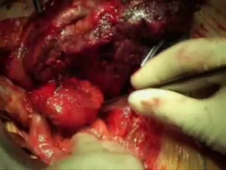 Spigelian Hernia Repair