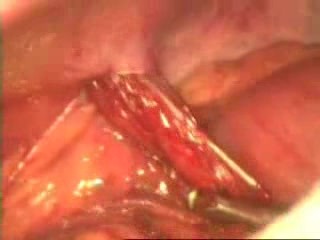 Laparoscopy Due To Penetrating Abdominal Trauma With A Prolapse