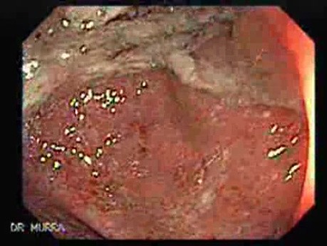 Ulcerative Colitis Complicating Colon Cancer (1 of 4)