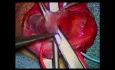 Sub Inguinal Varicocelectomy