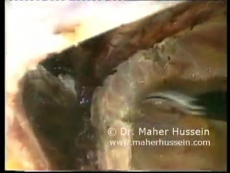 Inguinal Herniorraphy - Laparoscopic Approach