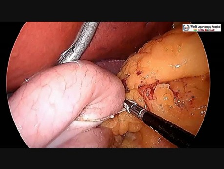 Sleeve Gastrectomy - Tips and Tricks