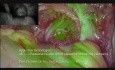 ICG Rectum Anastomose
