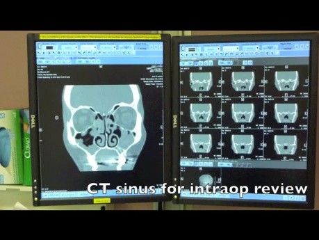 FESS Intro for Surgeons