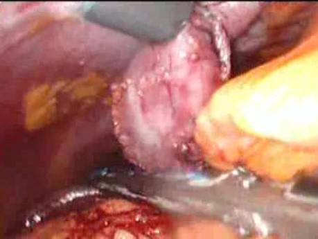 Gastrointestinal Stromal Tumor - GIST (47 of 65)