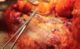 Autologous Breast Reconstruction Using a Pedicled Transverse Rectus Abdominis Flap (TRAM)