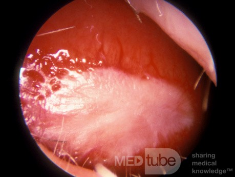 Hyperkeratosis of the Nasal Septum