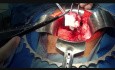 Hysterectomy - Open Method