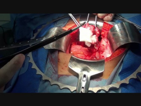 Hysterectomy - Open Method