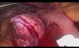 One Anastomosis Gastric Bypass