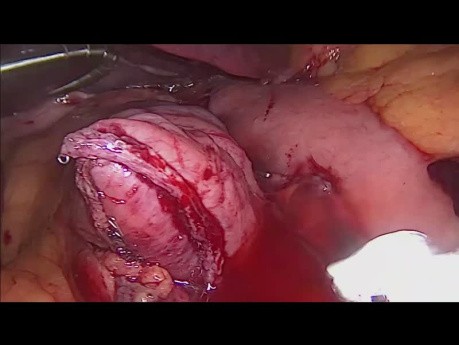 One Anastomosis Gastric Bypass