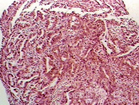 Barrett Adenocarcinoma - Endoscopic Image  (8 of 20)