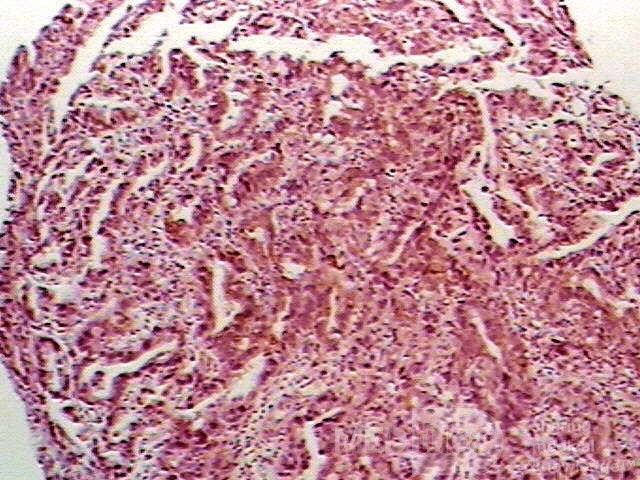 Barrett Adenocarcinoma - Endoscopic Image  (8 of 20)