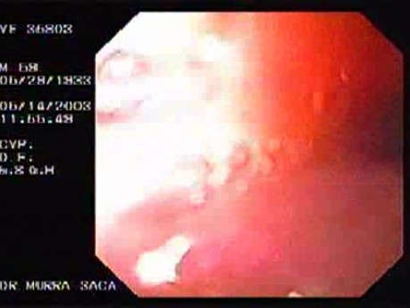 Zenker's Diverticulum - 68 Years-Old Male