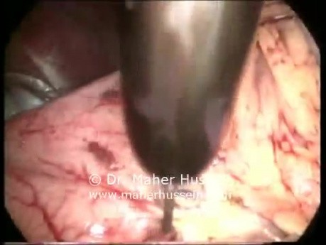 Billroth II - Laparoscopic Approach