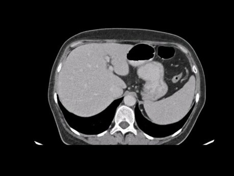Case Presentations: #1 Total Gastrectomy For Advanced Gastric Cancer #2 Right Hemicolectomy For Locally Invasive Right Colon Cancer