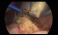 Laparoscopic Splenectomy