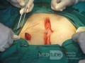 Multiple Rectal Ulcers (51 of 110)