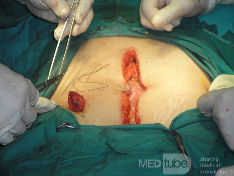 Multiple Rectal Ulcers (51 of 110)