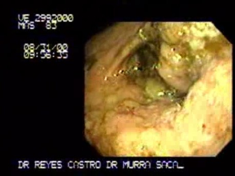 Gastric Carcinoma - Obstruction
