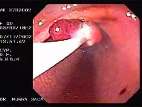 Polypectomy (4 of 6)