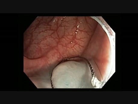 Colonoscopy - Subtle Serrated Adenoma in the Transverse Colon