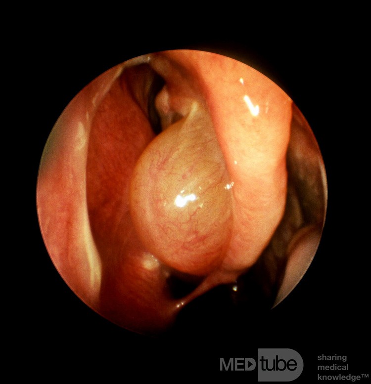 Nasal Polyp Arising from the Middle Turbinate