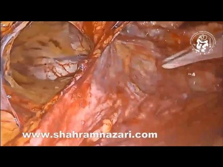 TAPP  Inguinal Hernia Repair