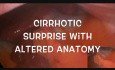 Laparoscopic Cholecystectomy with Incidental Cirrhosis