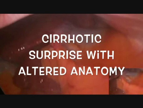 Laparoscopic Cholecystectomy with Incidental Cirrhosis