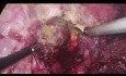 Thoracoscopic Liver Resection for Lesion Located in Segment 7