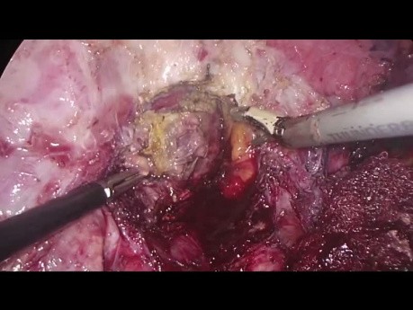 Thoracoscopic Liver Resection for Lesion Located in Segment 7