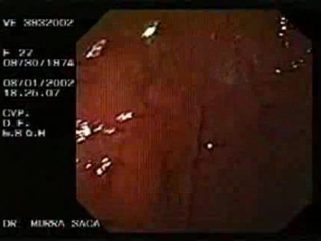 Post Fundoplication Endoscopic Examination (5 of 5)