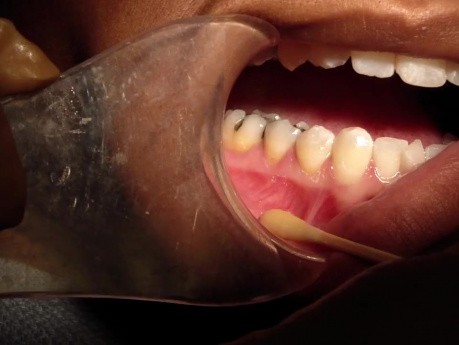 What Is This Thing Called The Mucogingival Junction?