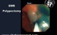 Endoscopic Mucosal Resection (EMR) in the Management of Colorectal Polyps