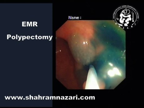 Endoscopic Mucosal Resection (EMR) in the Management of Colorectal Polyps