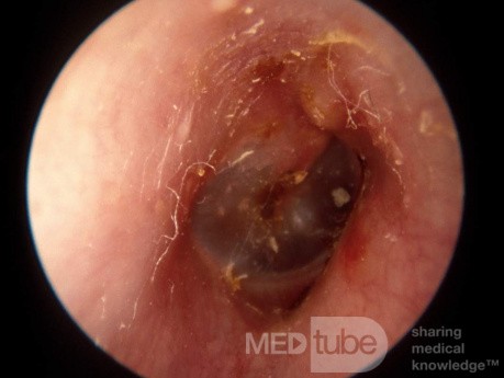 Chronic Otitis Externa due to Chronic Local Trauma