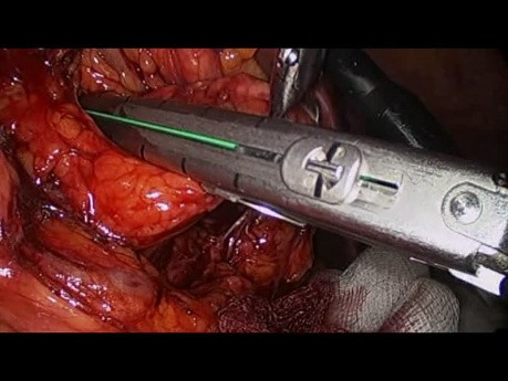 Laparoscopic Resection of the Pancreatic Tail