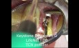 Implant Micro Surgery: Immediate Implant and Provisional