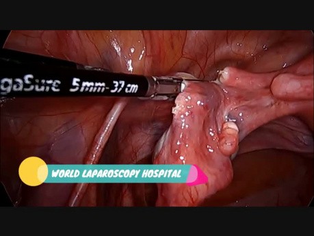 Skin to Skin Total Laparoscopic Hysterectomy with Infrared Ureteric Stent
