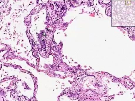 Metastatic calcification - Histopathology - Lung, kidney