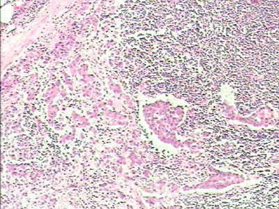 Adenocarcinoma of the cardias and gastric fundus with signet-ring cells (22 of 25)