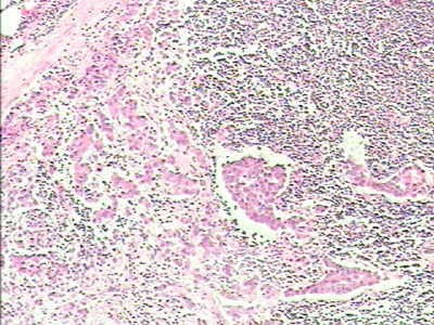 Adenocarcinoma of the cardias and gastric fundus with signet-ring cells (22 of 25)