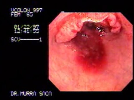 Endoscopy Of Rectal Adenocarcinoma (3 of 4)