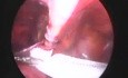 Laparoscopic inguinal hernia repair