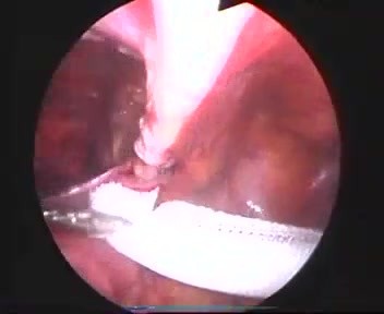 Laparoscopic inguinal hernia repair