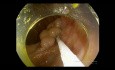 ESD of LST-G in Ascending Colon - Unedited Video of the Procedure