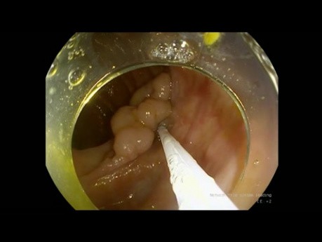 ESD of LST-G in Ascending Colon - Unedited Video of the Procedure